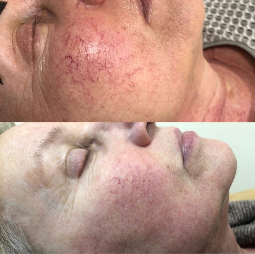 Zamykanie naczynek na twarzy