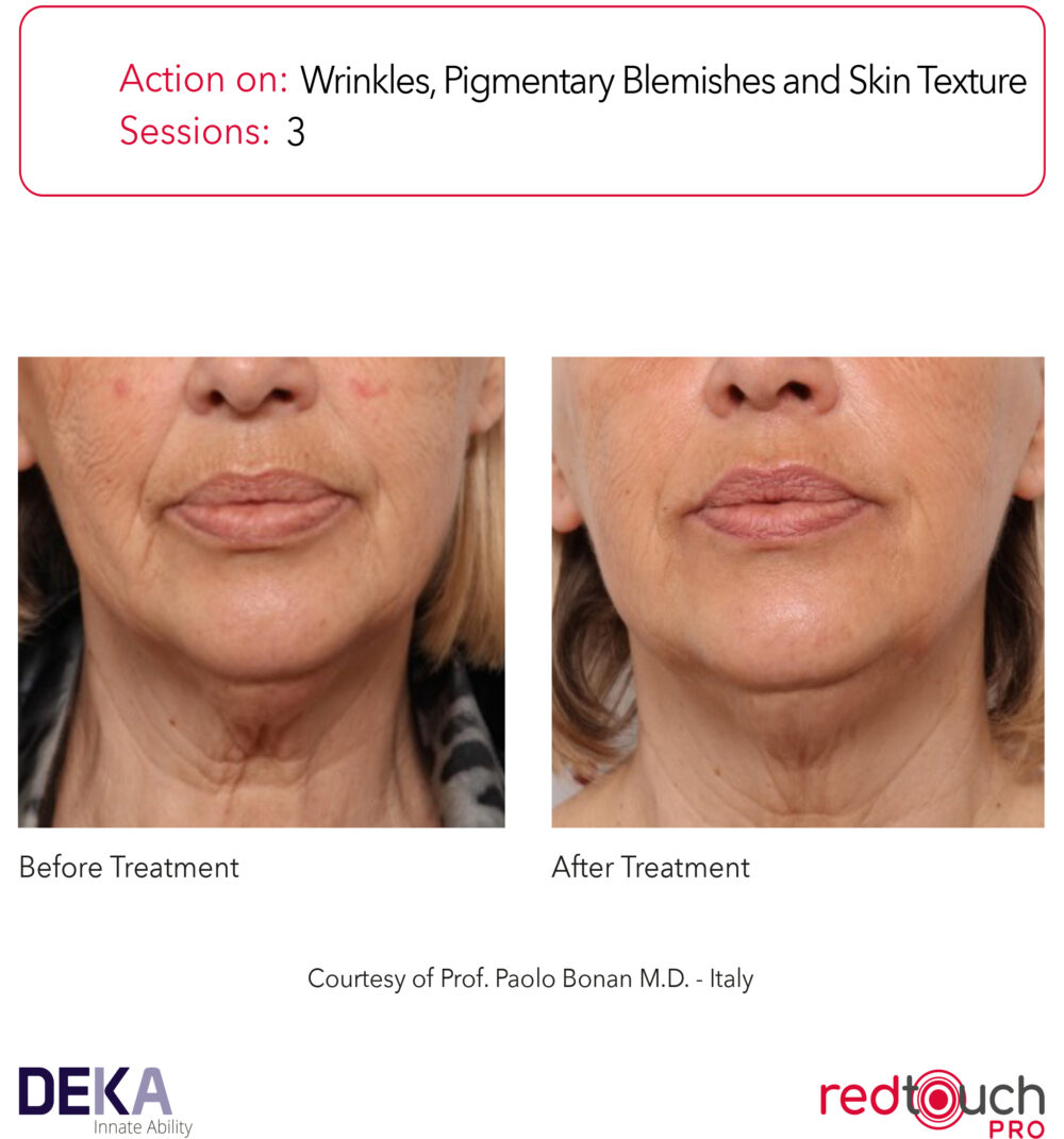 RedTouch Pro efekty zabiegu 11