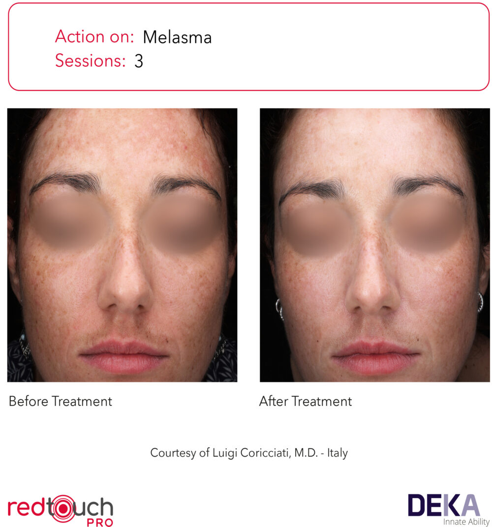 RedTouch Pro efekty zabiegu 3