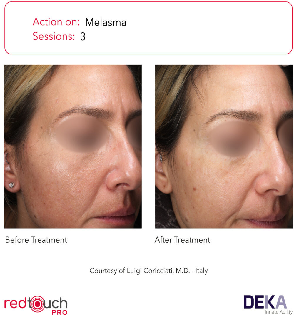 RedTouch Pro efekty zabiegu 6