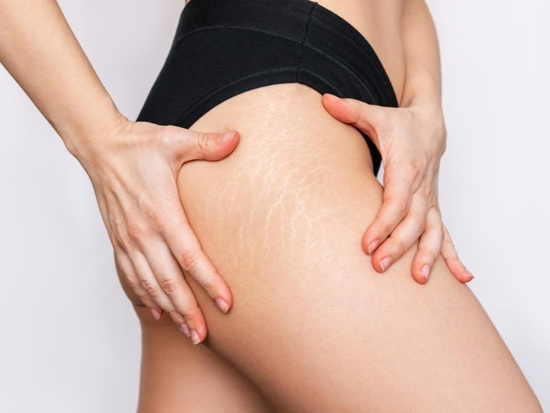 Rozstępy – dlaczego powstają i co zrobić, aby skutecznie się ich pozbyć Hamak SPA