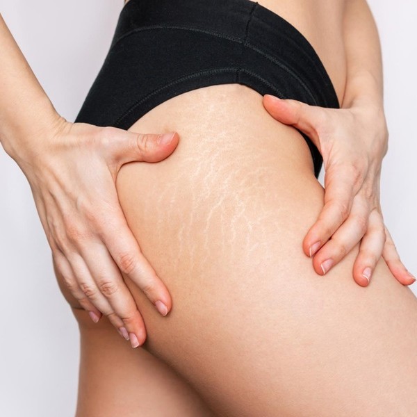 usuwanie rozstępów Hamak SPA
